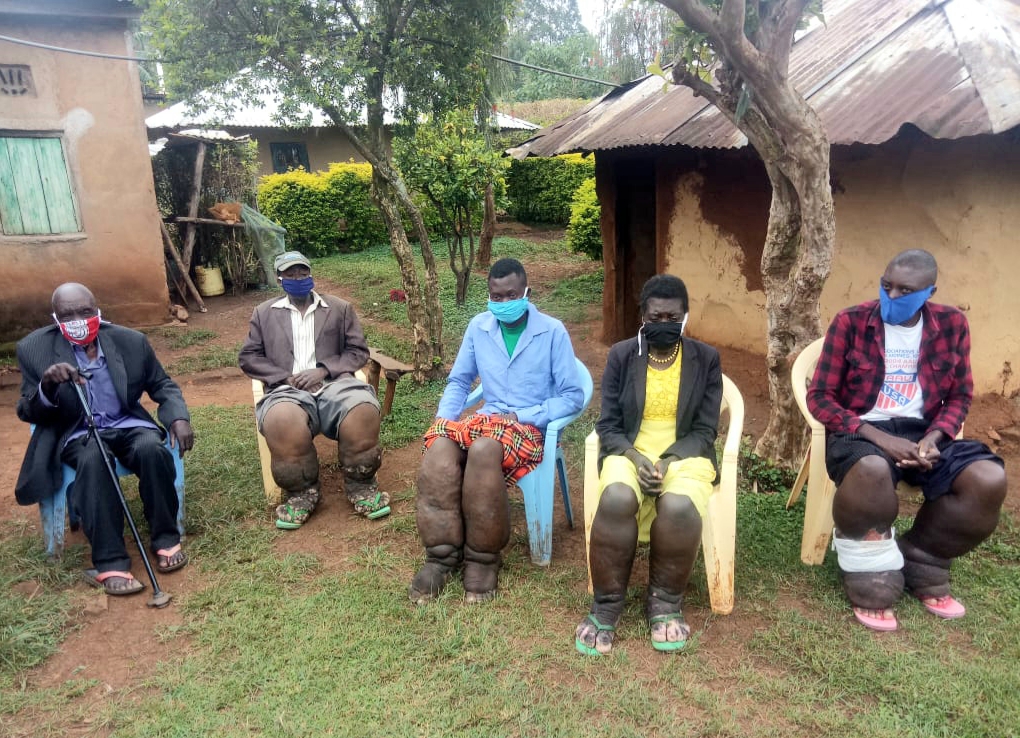 Family Members suffering from Elephantiasis